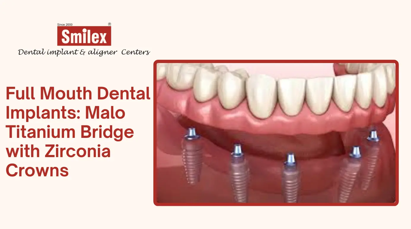 Full Mouth Dental Implants