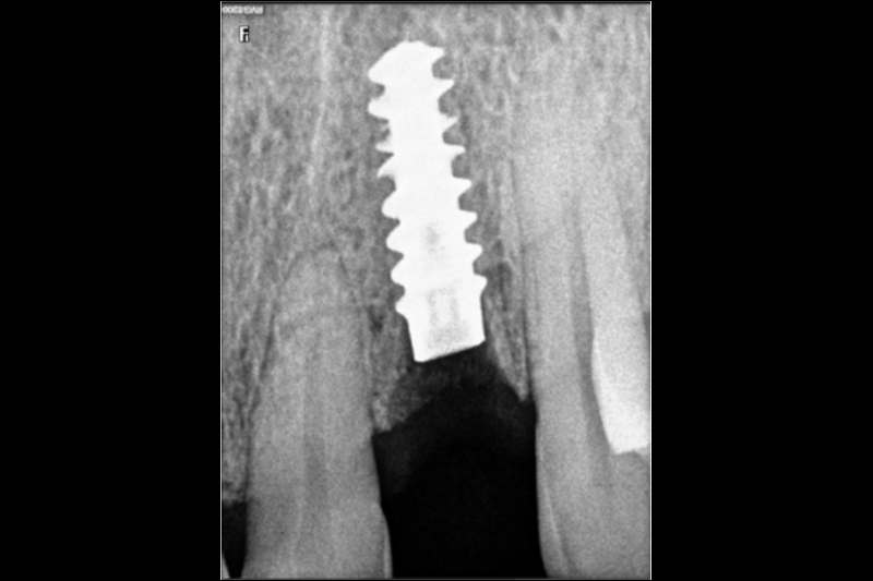 Quick and reliable same day implants.