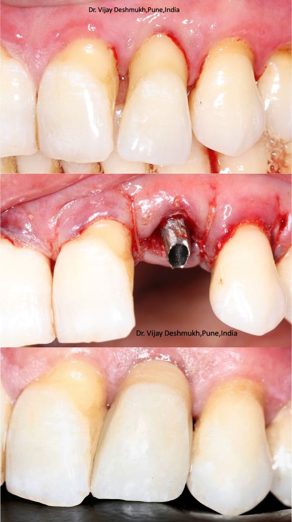 Get your same day dental implants in India at a great price.