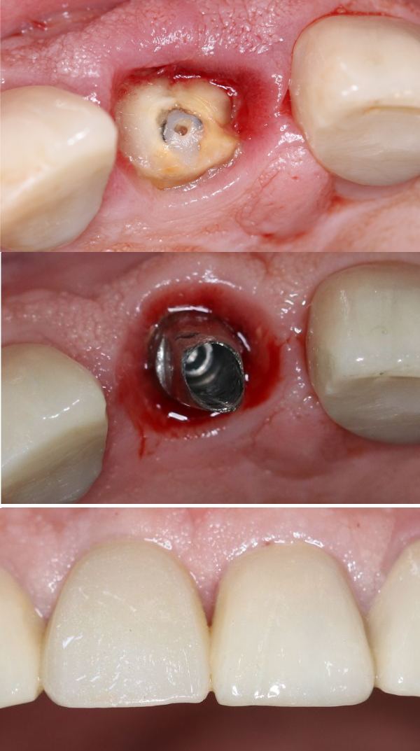 Affordable same day dental implants for a quick smile makeover.