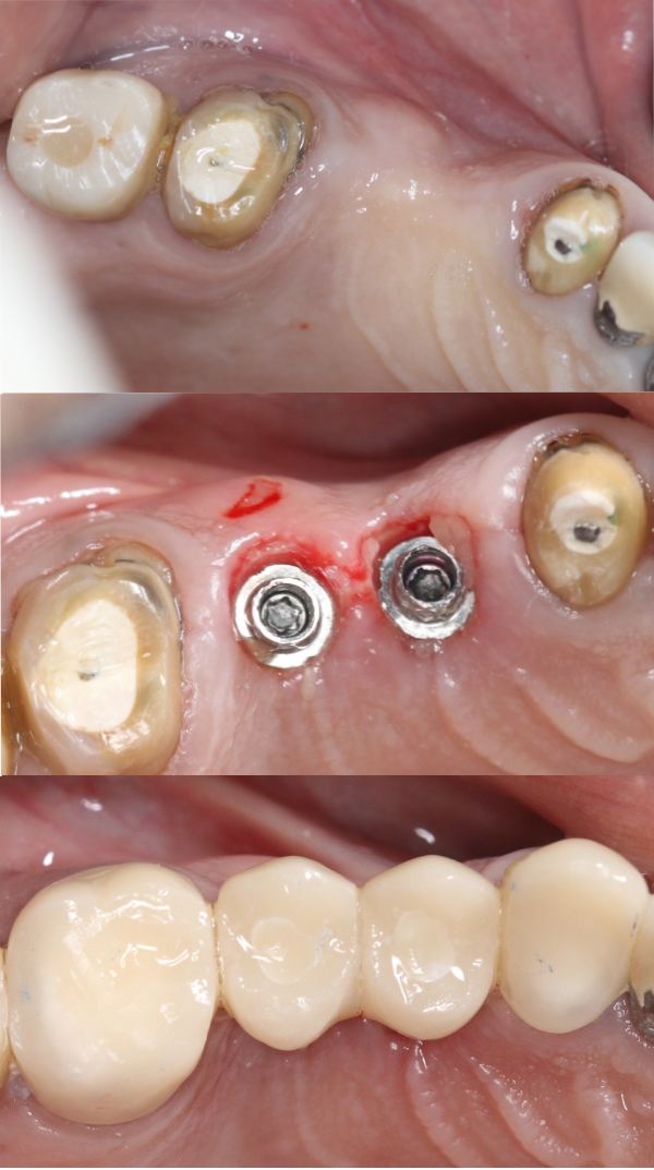 Restore your smile with same day implant dentures today.