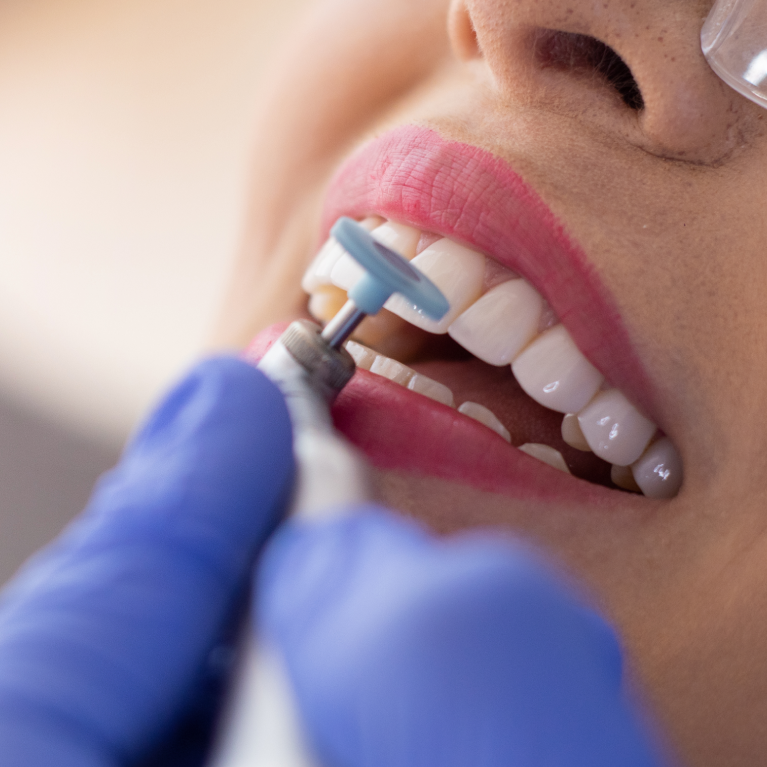 Full Mouth Rehabilitation