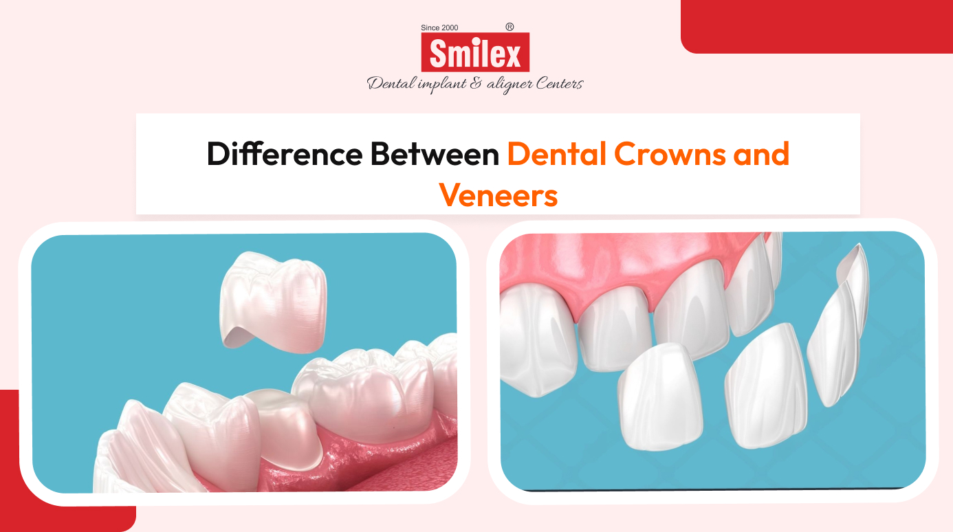 Dental Crowns and Veneers