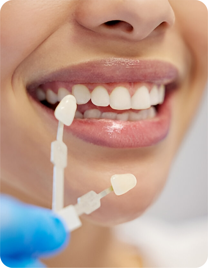 Veneers and Composite Bonding