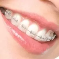Ceramic braces