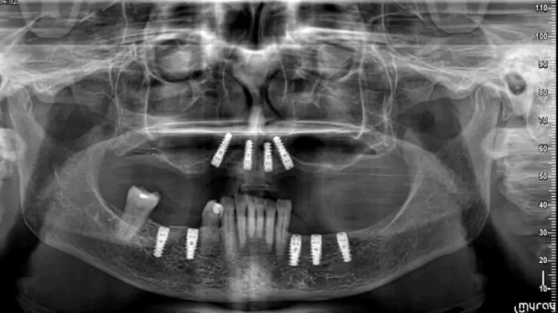 Full Mouth Dental Implants