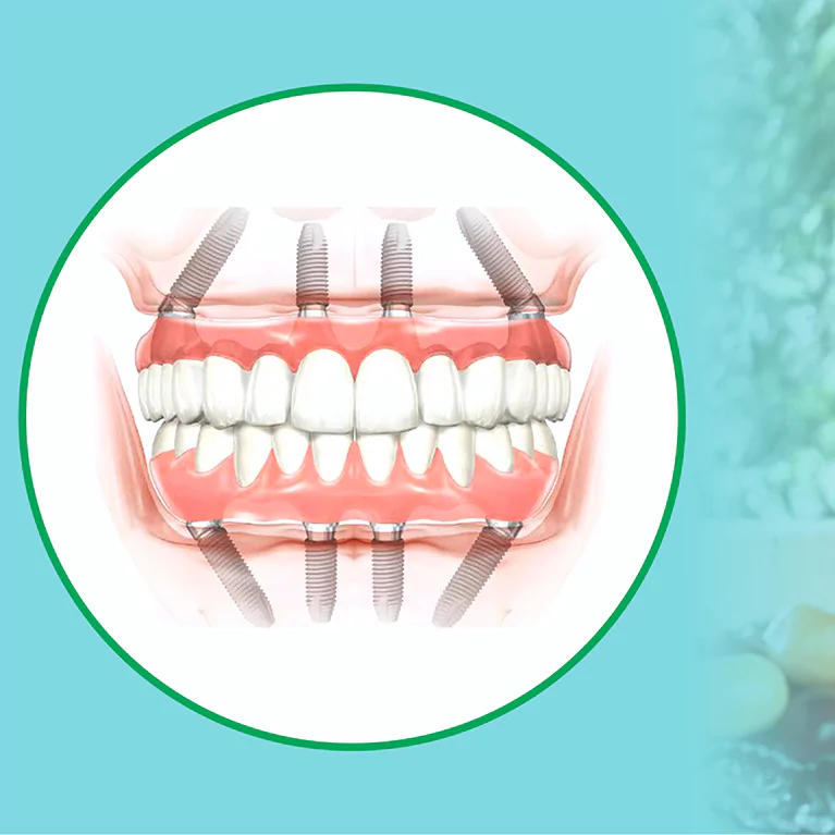 Full Mouth Dental Implants