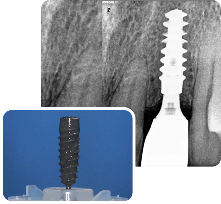 Single Tooth Implant