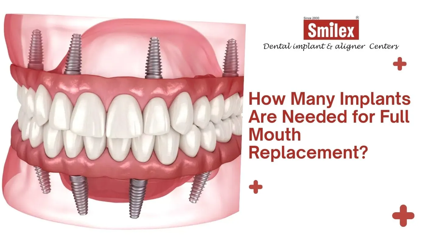 Full Mouth Dental Implants